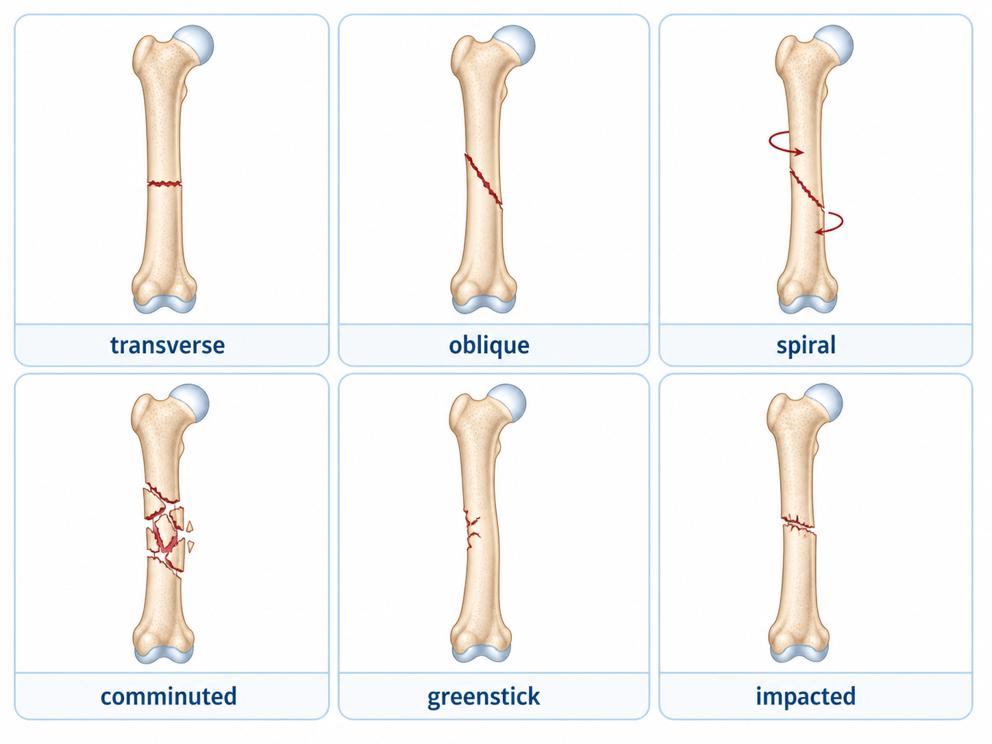 Orthopedic medical illustration showing transverse, oblique, spiral, comminuted, greenstick, and impacted fracture types
